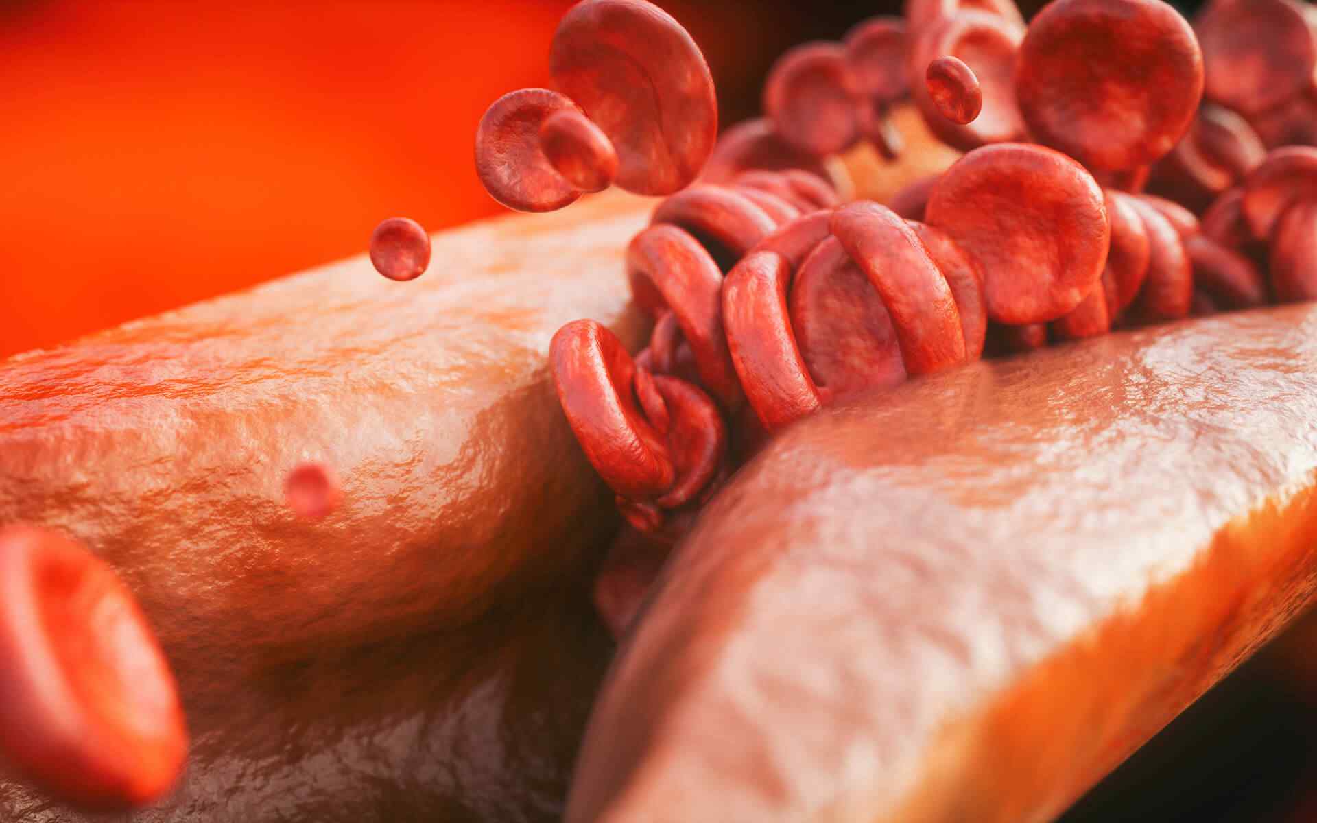 What Causes High Blood Pressure?